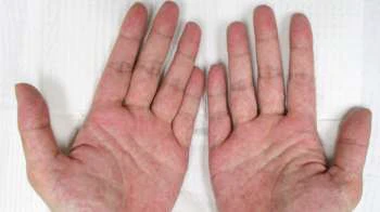 Fatty liver symptoms: 5 signs of the liver condition that can appear on your hands